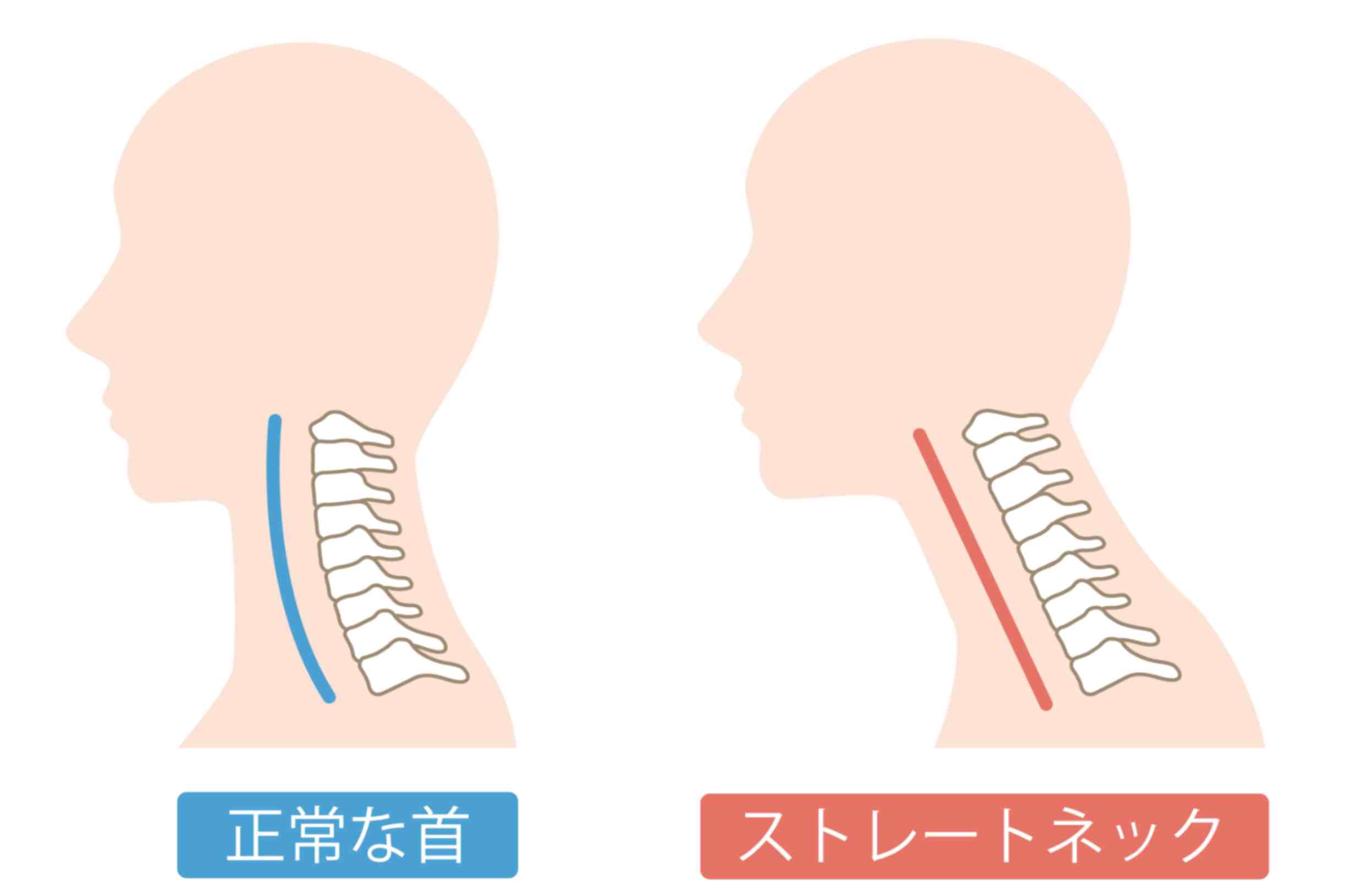 ストレートネック（スマホ首）とは？